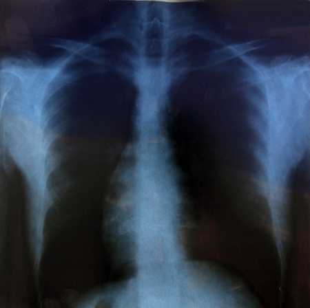 Chest x-rayの写真素材