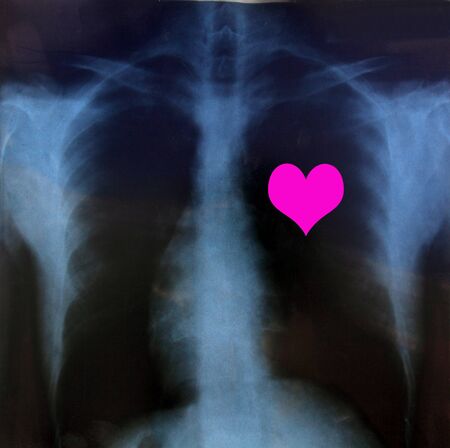 Chest x-ray with heart