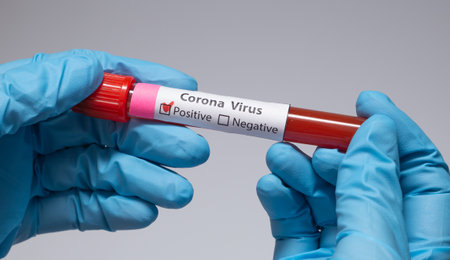 Blood positive test to coronavirus. Medical reseach, test-tube with blood, hand in latex medical gloves. Coronavirus outbreak and influenza. 2019-nCoV, covid-19, sars. High quality photoの写真素材
