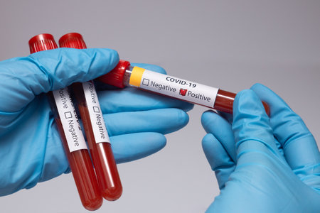 Blood positive test to coronavirus. Medical reseach, test-tube with blood, hand in latex medical gloves. Coronavirus outbreak and influenza. 2019-nCoV, covid-19, sars. High quality photo.の写真素材