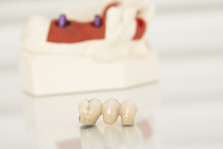 Metal free ceramic dental crowns