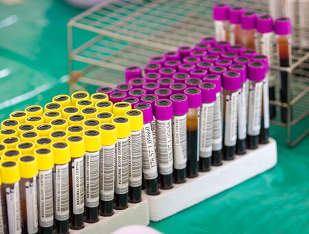 arranges test tubes with blood on a trayのeditorial素材