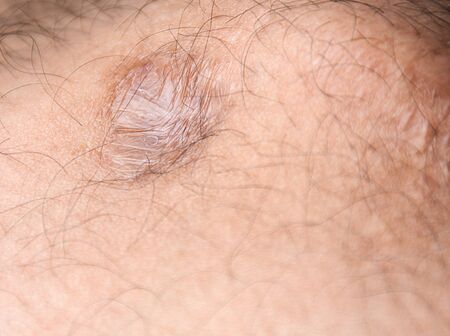 Scar on human torn skin - selective focusの写真素材