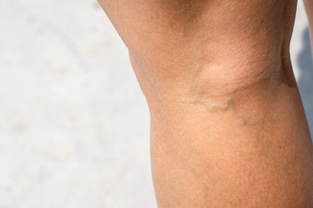 Painful varicose and spider veins on womans legsà¹の写真素材