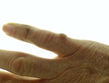 Hand of an elderly man on white background showing a benign malformation of the skin, a wart with...