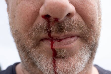 Nosebleed , an old man with a bloody nose. Healthcare and medical concept.