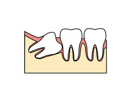 Clip art of Wisdom teeth.のイラスト素材