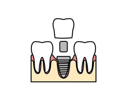 Clip art of Implant treatment.のイラスト素材