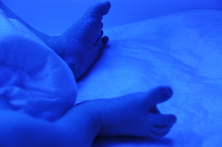 Newborn with jaundice under ultraviolet lightの写真素材