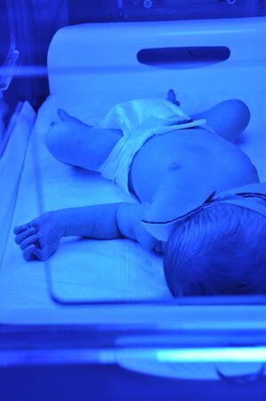 Newborn with jaundice under ultraviolet lightの写真素材