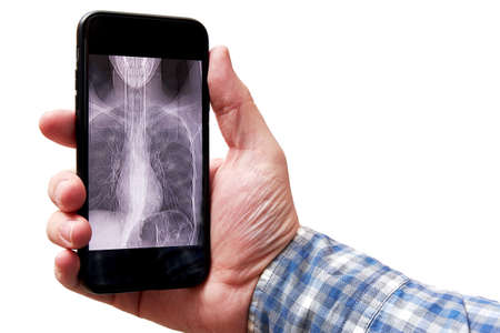 Mans hand holding a mobile phone with a CT scan image of lungs. Pneumonia and disease diagnosisの写真素材