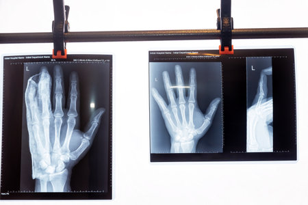 Three different x-ray views of a hand with broken finger are displayed, showing the hand in PA and...