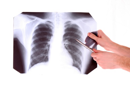 X-Ray Image of chest isolated on white. Showing something with pen