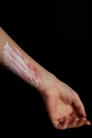 Treatment of burns on female hand on black backgroundの写真素材