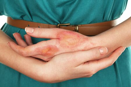 Horrible burns on female hand on white background