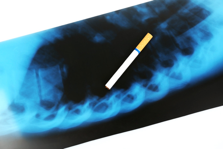 Cigarette on x-ray lung, close upの写真素材