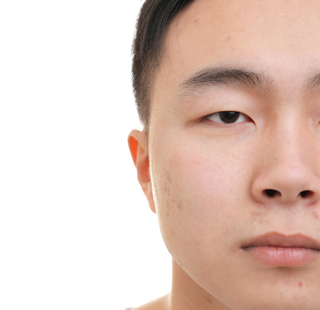 Young Asian man with problem skin on white background, closeupの写真素材