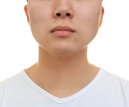 Handsome young man with problem skin on white background, closeup
