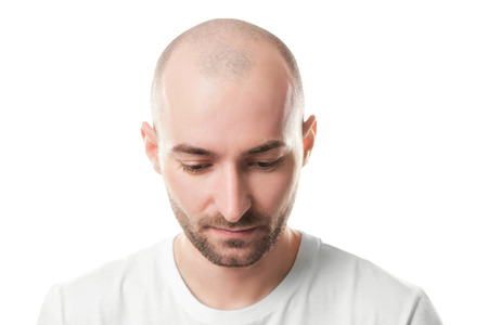 Hair loss concept. Portrait of young bald man on white background