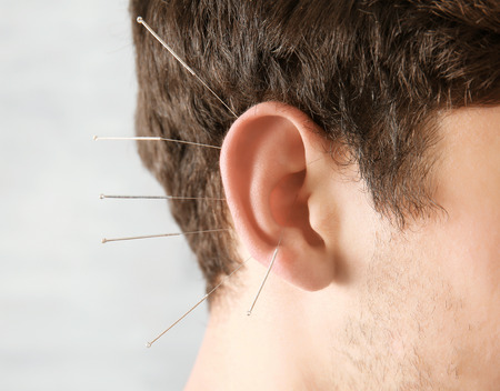 Man's ear with needles, closeup. Acupuncture conceptの写真素材