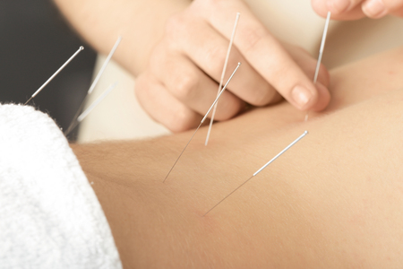 Young man getting acupuncture treatment, closeupの写真素材