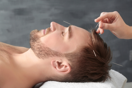 Young man getting acupuncture treatment, closeupの写真素材