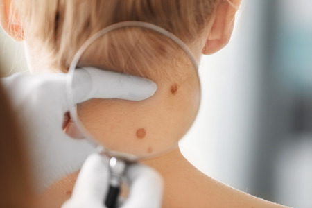 Dermatologist examining birthmark of patient, closeup. Cancer concept