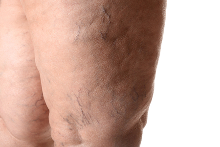 Woman's legs with varicose on white background, closeupの写真素材