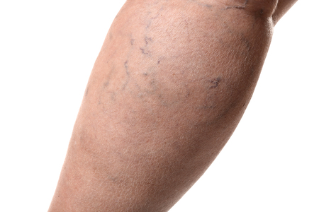 Woman's leg with varicose on white background, closeupの写真素材