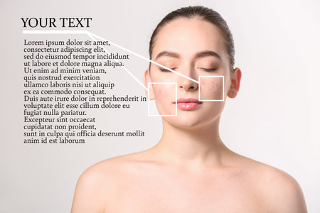Young woman with problem skin and space for text on gray backgroundの写真素材