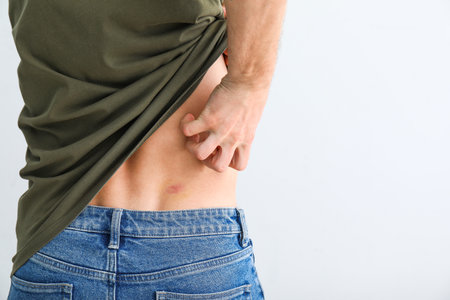 Young man with skin allergy on light backgroundの写真素材