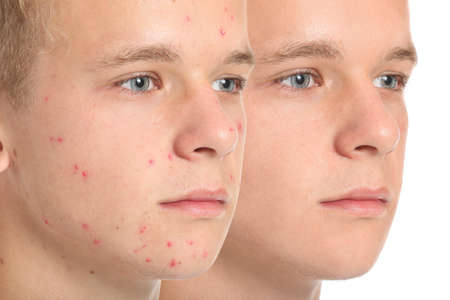 Teenage boy before and after acne treatment on white backgroundの写真素材