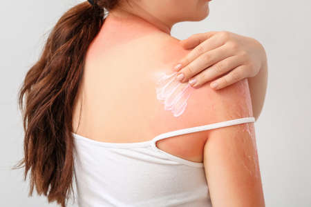 Woman with red sunburned skin applying cream against light background, closeup