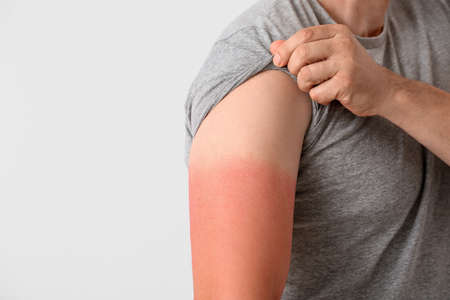 Man with red sunburned skin against light background, closeupの写真素材
