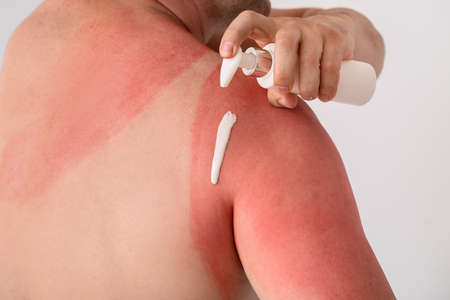 Man with red sunburned skin applying cream against light background, closeupの写真素材