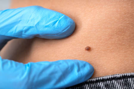 Dermatologist examining patient in clinic, closeupの写真素材