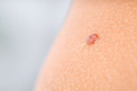 Human skin with mole, closeupの写真素材
