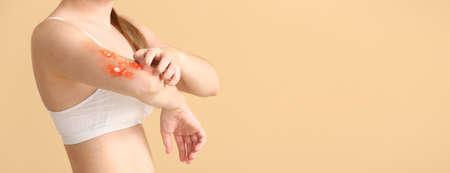 Woman ill with monkeypox on beige background with space for textの写真素材