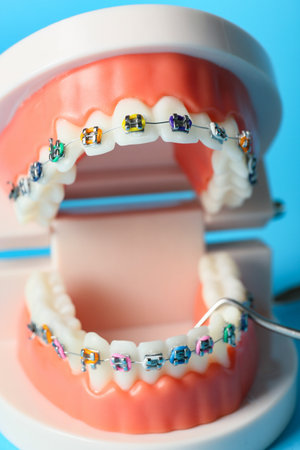 Model of jaw with braces on blue background, closeupの写真素材