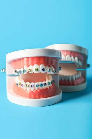 Model of jaws with braces on blue background