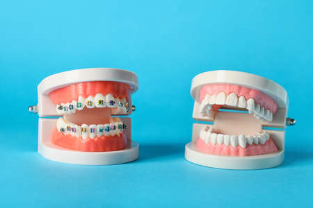 Model of jaws with braces on blue backgroundの写真素材
