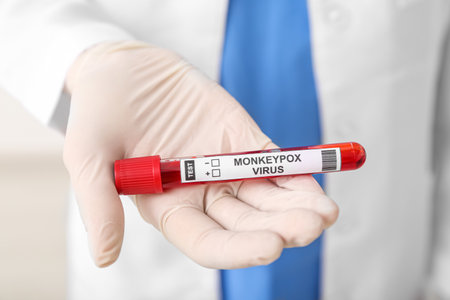Female doctor with blood sample on light background, closeup. Monkeypox virus concept