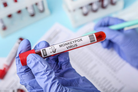 Female doctor with blood sample on blue background, closeup. Monkeypox virus conceptの写真素材