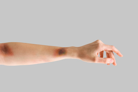 Bruised female hand on gray backgroundの写真素材