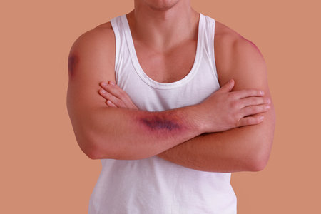 Man with bruises on arm against beige backgroundの写真素材