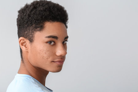 African-American teenage boy with acne problem on light backgroundの写真素材