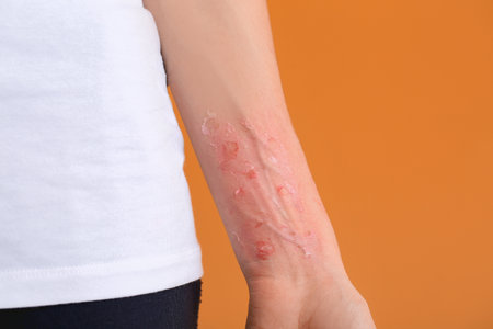 Woman with red sunburned skin against color background, closeupの写真素材