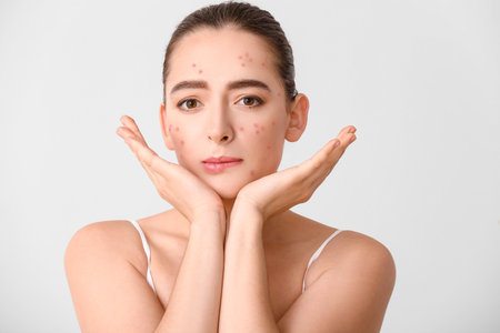 Young woman with acne problem on light backgroundの写真素材