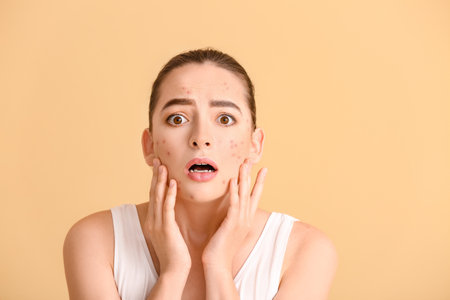 Stressed young woman with acne problem on color backgroundの写真素材