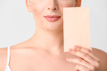 Young woman with acne problem and blank card on light background, closeupの写真素材